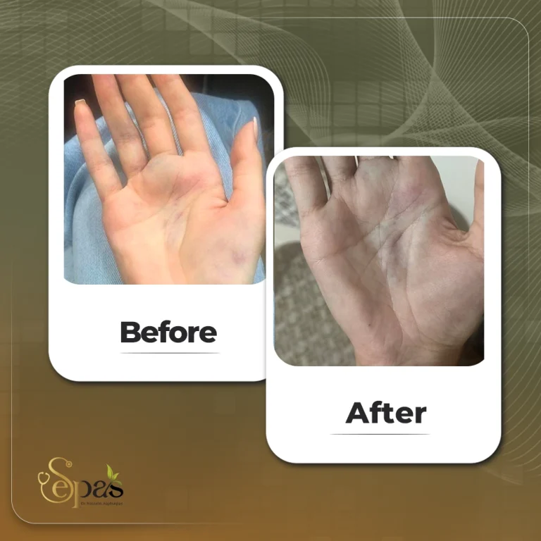 درمان همانژیوم