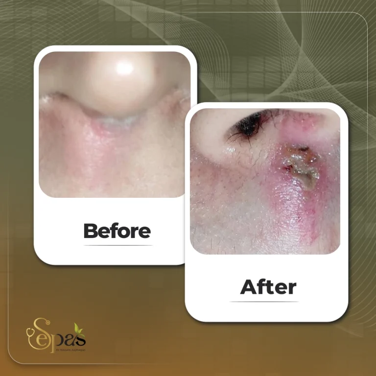 درمان همانژیوم