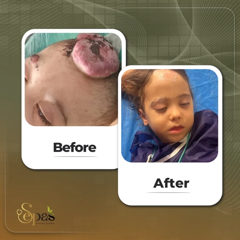 درمان همانژیوم