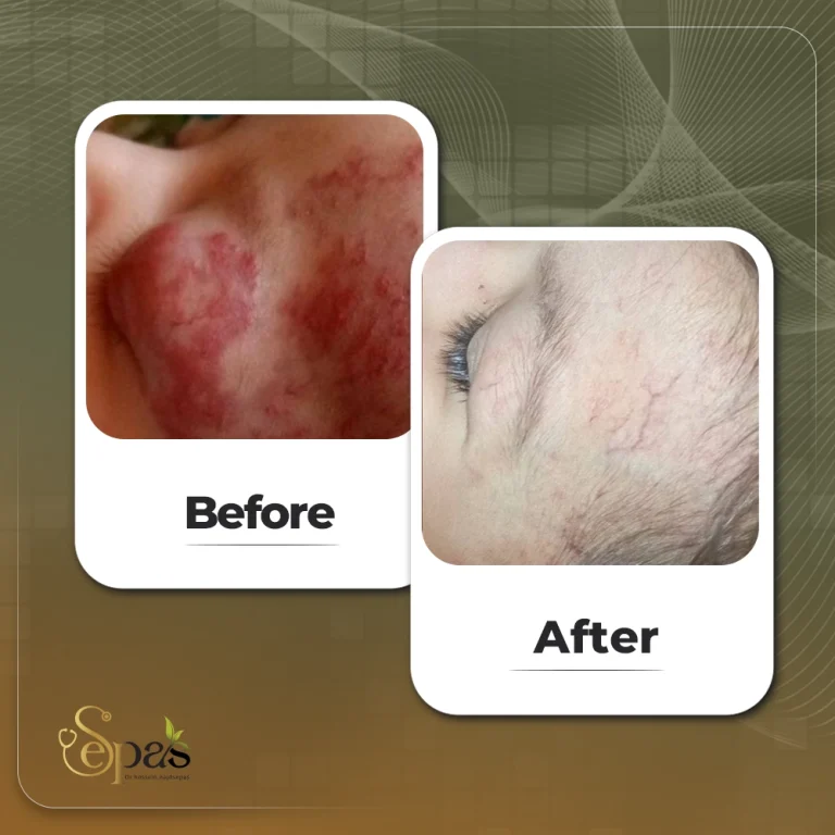 درمان همانژیوم